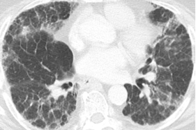 ero为什么不显示叶俏教授：HRCT是发现和鉴别「过敏性肺炎」的重要环节，何种表现指向预后不良？使患者发病的危害因素躲在哪些环境中？_https://www.jmylbn.com_新闻资讯_第40张