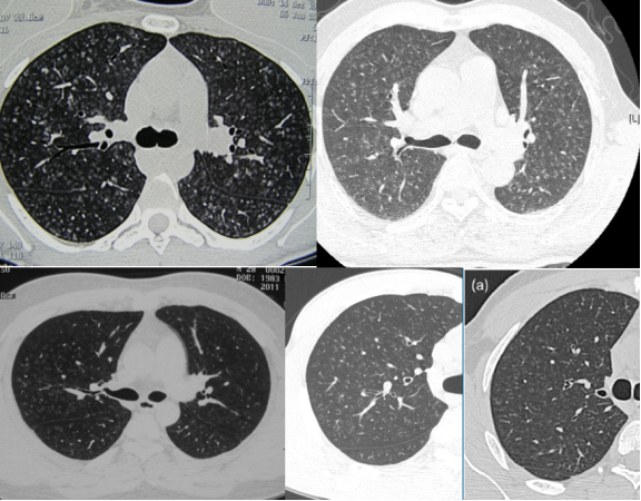 ero为什么不显示叶俏教授：HRCT是发现和鉴别「过敏性肺炎」的重要环节，何种表现指向预后不良？使患者发病的危害因素躲在哪些环境中？_https://www.jmylbn.com_新闻资讯_第44张