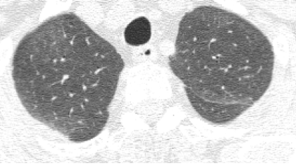 ero为什么不显示叶俏教授：HRCT是发现和鉴别「过敏性肺炎」的重要环节，何种表现指向预后不良？使患者发病的危害因素躲在哪些环境中？_https://www.jmylbn.com_新闻资讯_第23张
