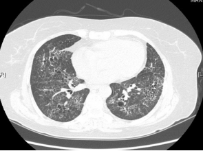 ero为什么不显示叶俏教授：HRCT是发现和鉴别「过敏性肺炎」的重要环节，何种表现指向预后不良？使患者发病的危害因素躲在哪些环境中？_https://www.jmylbn.com_新闻资讯_第41张
