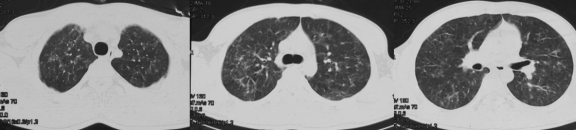 ero为什么不显示叶俏教授：HRCT是发现和鉴别「过敏性肺炎」的重要环节，何种表现指向预后不良？使患者发病的危害因素躲在哪些环境中？_https://www.jmylbn.com_新闻资讯_第45张