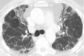 ero为什么不显示叶俏教授：HRCT是发现和鉴别「过敏性肺炎」的重要环节，何种表现指向预后不良？使患者发病的危害因素躲在哪些环境中？_https://www.jmylbn.com_新闻资讯_第39张