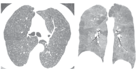 ero为什么不显示叶俏教授：HRCT是发现和鉴别「过敏性肺炎」的重要环节，何种表现指向预后不良？使患者发病的危害因素躲在哪些环境中？_https://www.jmylbn.com_新闻资讯_第22张