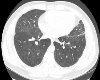 ero为什么不显示叶俏教授：HRCT是发现和鉴别「过敏性肺炎」的重要环节，何种表现指向预后不良？使患者发病的危害因素躲在哪些环境中？_https://www.jmylbn.com_新闻资讯_第18张