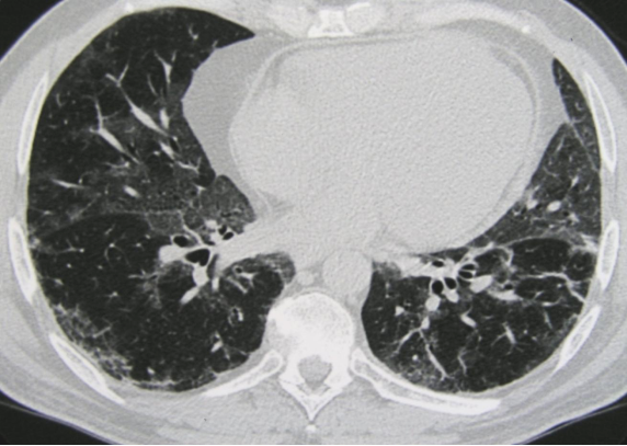 ero为什么不显示叶俏教授：HRCT是发现和鉴别「过敏性肺炎」的重要环节，何种表现指向预后不良？使患者发病的危害因素躲在哪些环境中？_https://www.jmylbn.com_新闻资讯_第33张