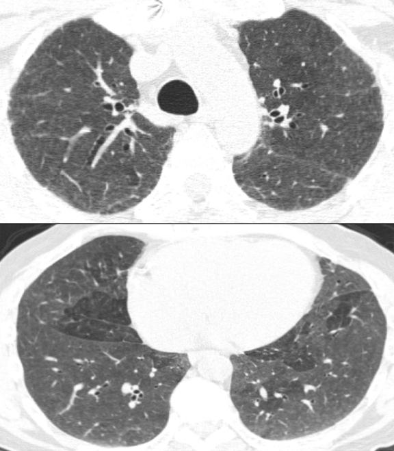 ero为什么不显示叶俏教授：HRCT是发现和鉴别「过敏性肺炎」的重要环节，何种表现指向预后不良？使患者发病的危害因素躲在哪些环境中？_https://www.jmylbn.com_新闻资讯_第34张