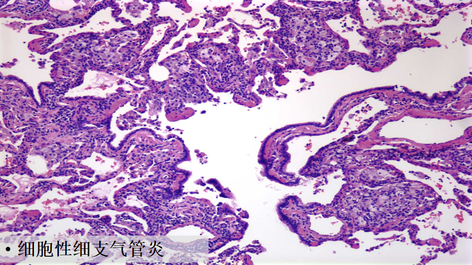 ero为什么不显示叶俏教授：HRCT是发现和鉴别「过敏性肺炎」的重要环节，何种表现指向预后不良？使患者发病的危害因素躲在哪些环境中？_https://www.jmylbn.com_新闻资讯_第59张