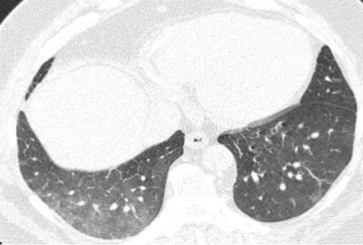 ero为什么不显示叶俏教授：HRCT是发现和鉴别「过敏性肺炎」的重要环节，何种表现指向预后不良？使患者发病的危害因素躲在哪些环境中？_https://www.jmylbn.com_新闻资讯_第31张