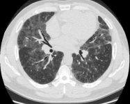 ero为什么不显示叶俏教授：HRCT是发现和鉴别「过敏性肺炎」的重要环节，何种表现指向预后不良？使患者发病的危害因素躲在哪些环境中？_https://www.jmylbn.com_新闻资讯_第19张