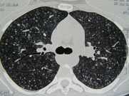 ero为什么不显示叶俏教授：HRCT是发现和鉴别「过敏性肺炎」的重要环节，何种表现指向预后不良？使患者发病的危害因素躲在哪些环境中？_https://www.jmylbn.com_新闻资讯_第5张
