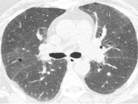 ero为什么不显示叶俏教授：HRCT是发现和鉴别「过敏性肺炎」的重要环节，何种表现指向预后不良？使患者发病的危害因素躲在哪些环境中？_https://www.jmylbn.com_新闻资讯_第24张