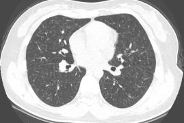 ero为什么不显示叶俏教授：HRCT是发现和鉴别「过敏性肺炎」的重要环节，何种表现指向预后不良？使患者发病的危害因素躲在哪些环境中？_https://www.jmylbn.com_新闻资讯_第28张