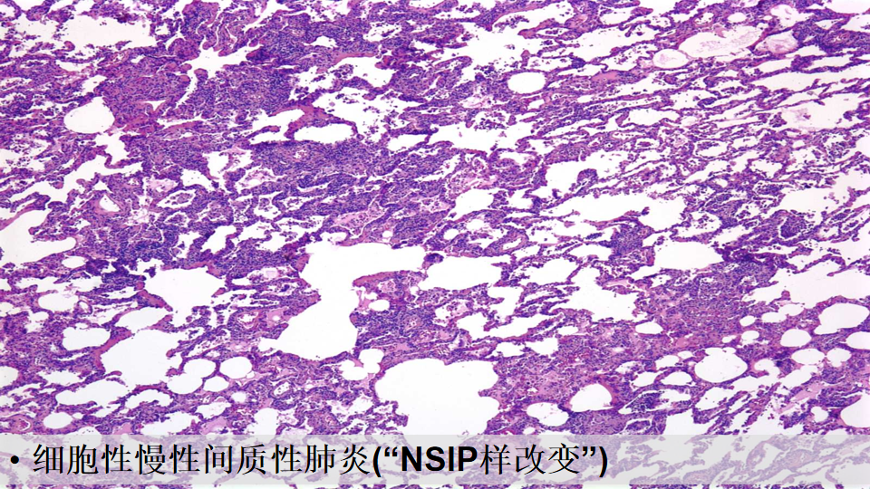 ero为什么不显示叶俏教授：HRCT是发现和鉴别「过敏性肺炎」的重要环节，何种表现指向预后不良？使患者发病的危害因素躲在哪些环境中？_https://www.jmylbn.com_新闻资讯_第61张