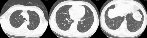 ero为什么不显示叶俏教授：HRCT是发现和鉴别「过敏性肺炎」的重要环节，何种表现指向预后不良？使患者发病的危害因素躲在哪些环境中？_https://www.jmylbn.com_新闻资讯_第47张
