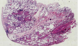 ero为什么不显示叶俏教授：HRCT是发现和鉴别「过敏性肺炎」的重要环节，何种表现指向预后不良？使患者发病的危害因素躲在哪些环境中？_https://www.jmylbn.com_新闻资讯_第49张