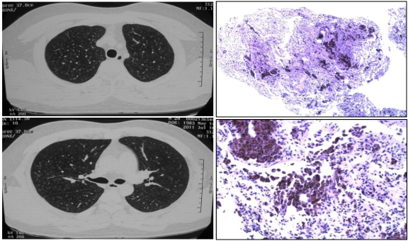 ero为什么不显示叶俏教授：HRCT是发现和鉴别「过敏性肺炎」的重要环节，何种表现指向预后不良？使患者发病的危害因素躲在哪些环境中？_https://www.jmylbn.com_新闻资讯_第51张
