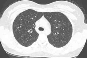 ero为什么不显示叶俏教授：HRCT是发现和鉴别「过敏性肺炎」的重要环节，何种表现指向预后不良？使患者发病的危害因素躲在哪些环境中？_https://www.jmylbn.com_新闻资讯_第27张