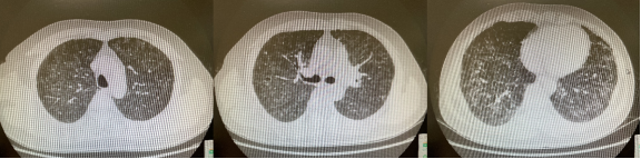 ero为什么不显示叶俏教授：HRCT是发现和鉴别「过敏性肺炎」的重要环节，何种表现指向预后不良？使患者发病的危害因素躲在哪些环境中？_https://www.jmylbn.com_新闻资讯_第57张