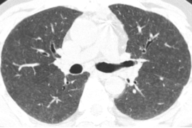 ero为什么不显示叶俏教授：HRCT是发现和鉴别「过敏性肺炎」的重要环节，何种表现指向预后不良？使患者发病的危害因素躲在哪些环境中？_https://www.jmylbn.com_新闻资讯_第35张