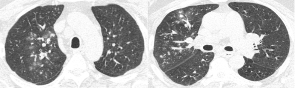 ero为什么不显示叶俏教授：HRCT是发现和鉴别「过敏性肺炎」的重要环节，何种表现指向预后不良？使患者发病的危害因素躲在哪些环境中？_https://www.jmylbn.com_新闻资讯_第30张