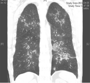 ero为什么不显示叶俏教授：HRCT是发现和鉴别「过敏性肺炎」的重要环节，何种表现指向预后不良？使患者发病的危害因素躲在哪些环境中？_https://www.jmylbn.com_新闻资讯_第42张