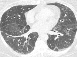 ero为什么不显示叶俏教授：HRCT是发现和鉴别「过敏性肺炎」的重要环节，何种表现指向预后不良？使患者发病的危害因素躲在哪些环境中？_https://www.jmylbn.com_新闻资讯_第25张