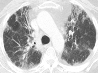 ero为什么不显示叶俏教授：HRCT是发现和鉴别「过敏性肺炎」的重要环节，何种表现指向预后不良？使患者发病的危害因素躲在哪些环境中？_https://www.jmylbn.com_新闻资讯_第6张