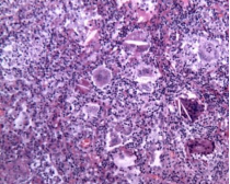 ero为什么不显示叶俏教授：HRCT是发现和鉴别「过敏性肺炎」的重要环节，何种表现指向预后不良？使患者发病的危害因素躲在哪些环境中？_https://www.jmylbn.com_新闻资讯_第21张