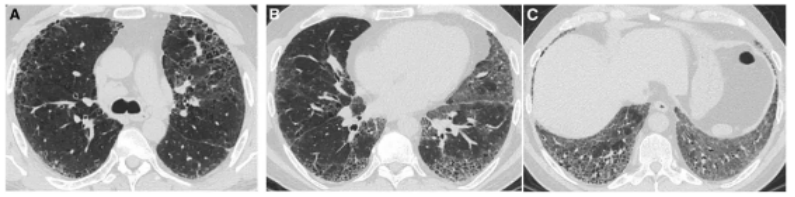 ero为什么不显示叶俏教授：HRCT是发现和鉴别「过敏性肺炎」的重要环节，何种表现指向预后不良？使患者发病的危害因素躲在哪些环境中？_https://www.jmylbn.com_新闻资讯_第56张