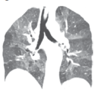 ero为什么不显示叶俏教授：HRCT是发现和鉴别「过敏性肺炎」的重要环节，何种表现指向预后不良？使患者发病的危害因素躲在哪些环境中？_https://www.jmylbn.com_新闻资讯_第26张