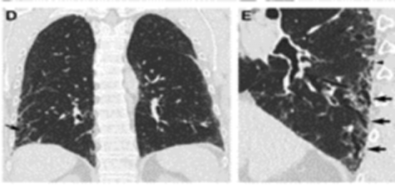 ero为什么不显示叶俏教授：HRCT是发现和鉴别「过敏性肺炎」的重要环节，何种表现指向预后不良？使患者发病的危害因素躲在哪些环境中？_https://www.jmylbn.com_新闻资讯_第55张