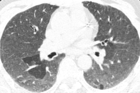 ero为什么不显示叶俏教授：HRCT是发现和鉴别「过敏性肺炎」的重要环节，何种表现指向预后不良？使患者发病的危害因素躲在哪些环境中？_https://www.jmylbn.com_新闻资讯_第36张