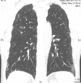 ero为什么不显示叶俏教授：HRCT是发现和鉴别「过敏性肺炎」的重要环节，何种表现指向预后不良？使患者发病的危害因素躲在哪些环境中？_https://www.jmylbn.com_新闻资讯_第43张