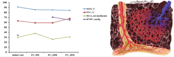 ero为什么不显示叶俏教授：HRCT是发现和鉴别「过敏性肺炎」的重要环节，何种表现指向预后不良？使患者发病的危害因素躲在哪些环境中？_https://www.jmylbn.com_新闻资讯_第53张