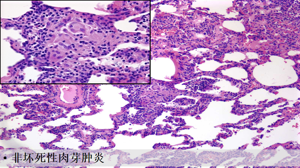ero为什么不显示叶俏教授：HRCT是发现和鉴别「过敏性肺炎」的重要环节，何种表现指向预后不良？使患者发病的危害因素躲在哪些环境中？_https://www.jmylbn.com_新闻资讯_第60张