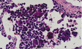 ero为什么不显示叶俏教授：HRCT是发现和鉴别「过敏性肺炎」的重要环节，何种表现指向预后不良？使患者发病的危害因素躲在哪些环境中？_https://www.jmylbn.com_新闻资讯_第50张