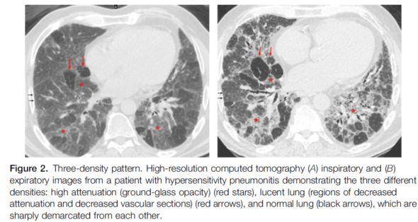 ero为什么不显示叶俏教授：HRCT是发现和鉴别「过敏性肺炎」的重要环节，何种表现指向预后不良？使患者发病的危害因素躲在哪些环境中？_https://www.jmylbn.com_新闻资讯_第37张