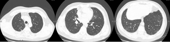 ero为什么不显示叶俏教授：HRCT是发现和鉴别「过敏性肺炎」的重要环节，何种表现指向预后不良？使患者发病的危害因素躲在哪些环境中？_https://www.jmylbn.com_新闻资讯_第48张