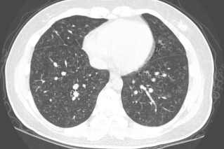 ero为什么不显示叶俏教授：HRCT是发现和鉴别「过敏性肺炎」的重要环节，何种表现指向预后不良？使患者发病的危害因素躲在哪些环境中？_https://www.jmylbn.com_新闻资讯_第29张