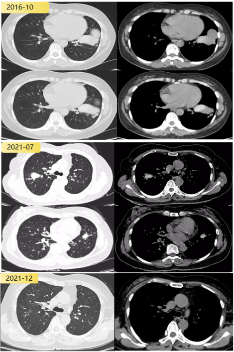 abp在医学是什么意思2021日本ABPA／ABPM诊断标准解读_https://www.jmylbn.com_新闻资讯_第12张