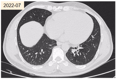 abp在医学是什么意思2021日本ABPA／ABPM诊断标准解读_https://www.jmylbn.com_新闻资讯_第17张