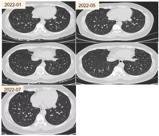 abp在医学是什么意思2021日本ABPA／ABPM诊断标准解读_https://www.jmylbn.com_新闻资讯_第15张