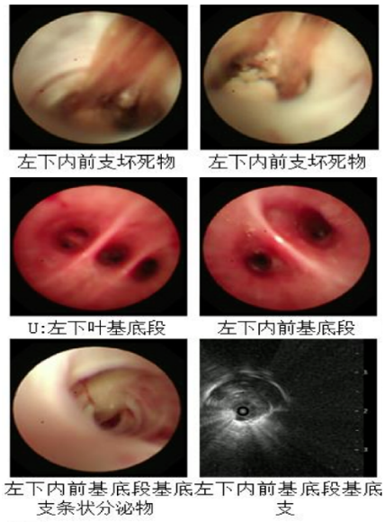 abp在医学是什么意思2021日本ABPA／ABPM诊断标准解读_https://www.jmylbn.com_新闻资讯_第14张