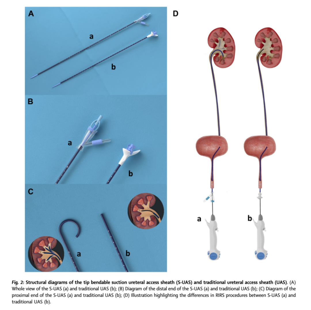 输尿管鞘是什么曾国华团队牵头国际多中心研究揭示末端可弯负压吸引鞘在输尿管软镜取石术中的优势_https://www.jmylbn.com_新闻资讯_第4张