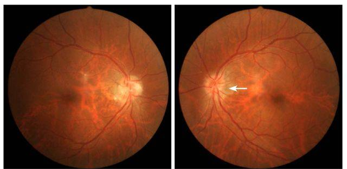 彩色眼底照相查什么【全国爱眼日】探秘神奇的眼底照相​_https://www.jmylbn.com_新闻资讯_第4张