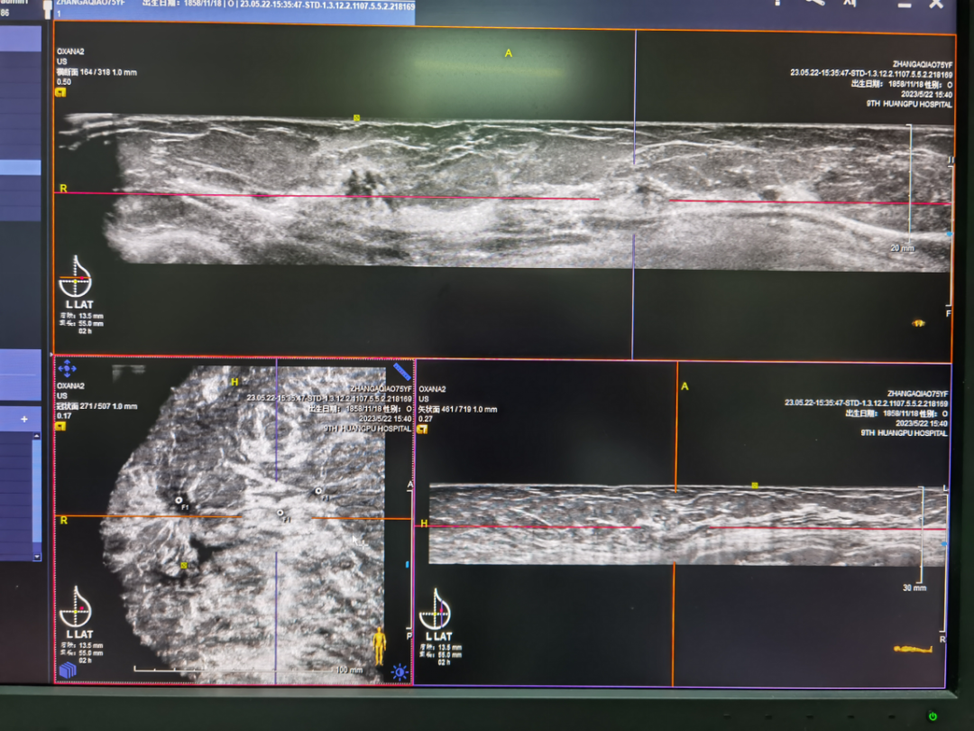 什么是超声容积探头乳腺超声诊断再上台阶——自动乳腺容积超声成像ABVS_https://www.jmylbn.com_新闻资讯_第8张