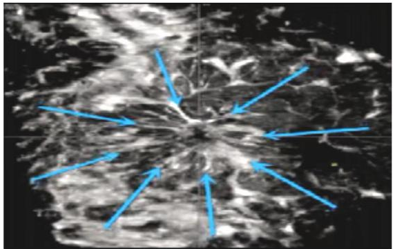 什么是超声容积探头乳腺超声诊断再上台阶——自动乳腺容积超声成像ABVS_https://www.jmylbn.com_新闻资讯_第13张