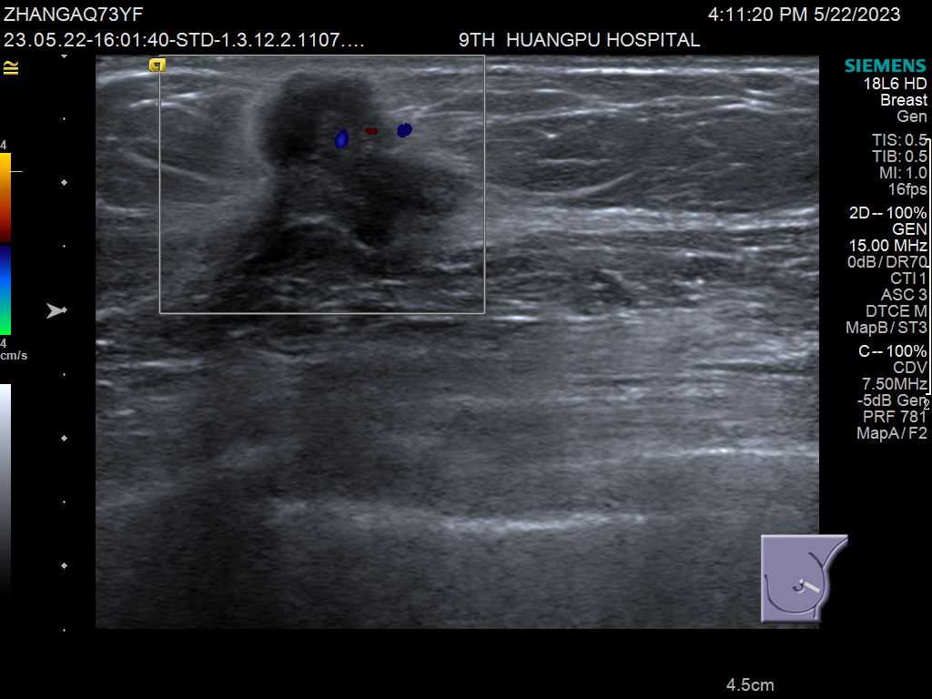 什么是超声容积探头乳腺超声诊断再上台阶——自动乳腺容积超声成像ABVS_https://www.jmylbn.com_新闻资讯_第6张