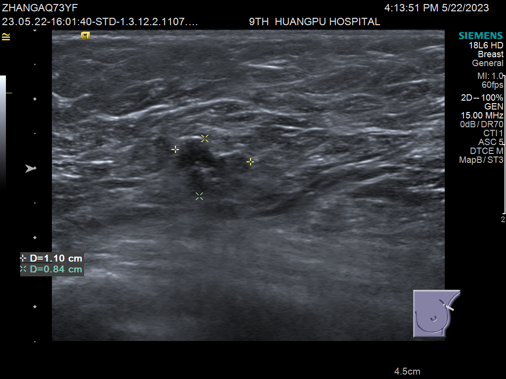 什么是超声容积探头乳腺超声诊断再上台阶——自动乳腺容积超声成像ABVS_https://www.jmylbn.com_新闻资讯_第7张