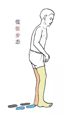 步态分析上曲线怎么解读步态分析知多少_https://www.jmylbn.com_新闻资讯_第6张